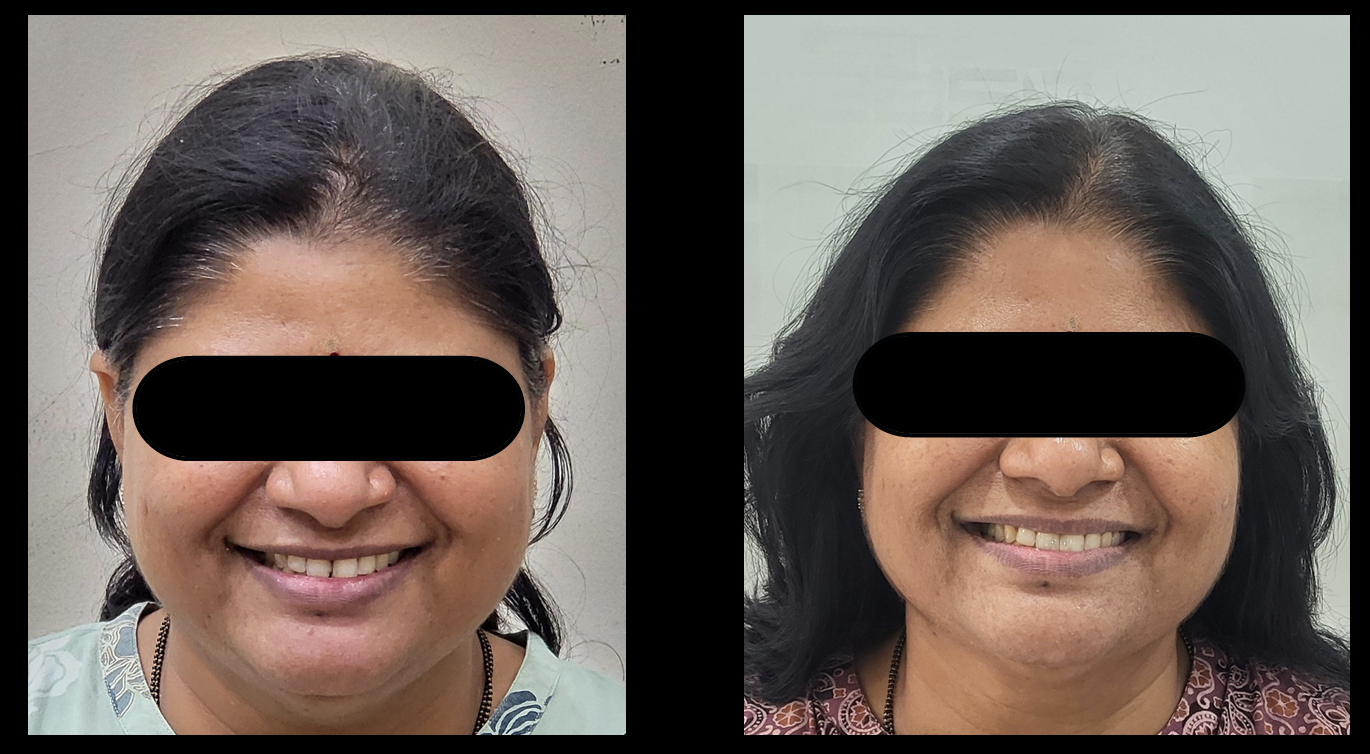 TMJ treatment result