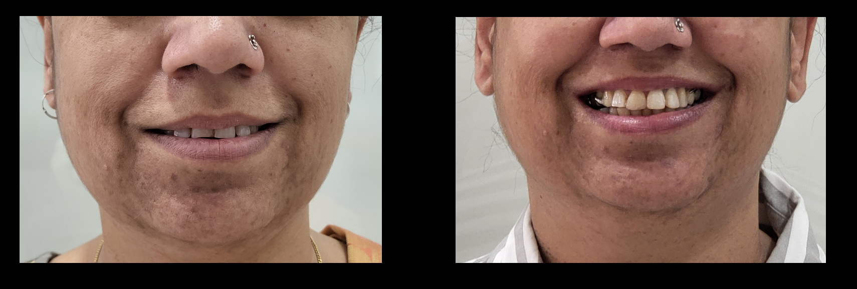 TMJ jaw pain before and after treatment