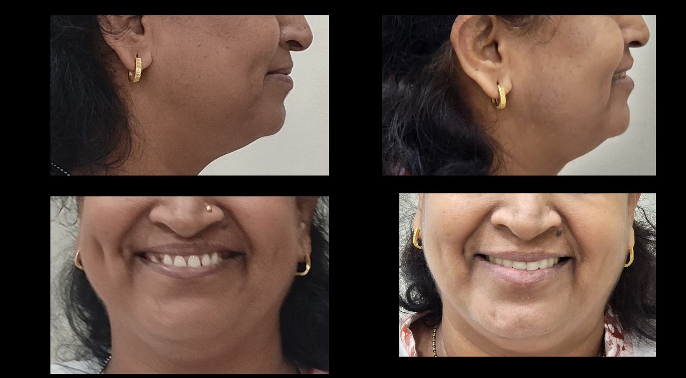 Jaw alignment before and after treatment