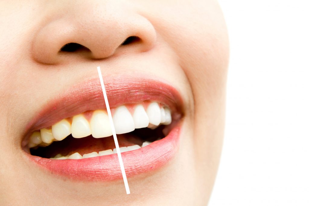 Brighten Your Smile with Teeth Whitening